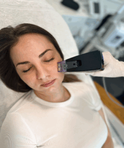 Radiofrequenz-Microneedling